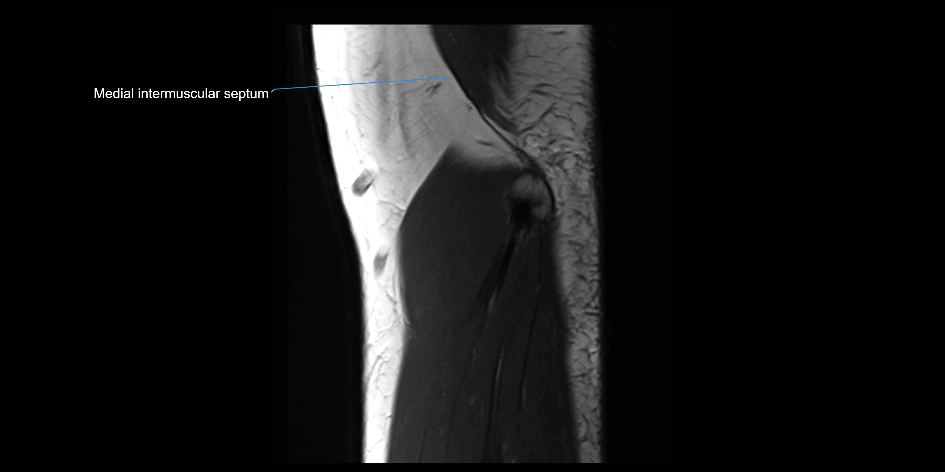 MRI elbow sagittal cross sectional anatomy 3T radiology  image-img-00001-00007.webp